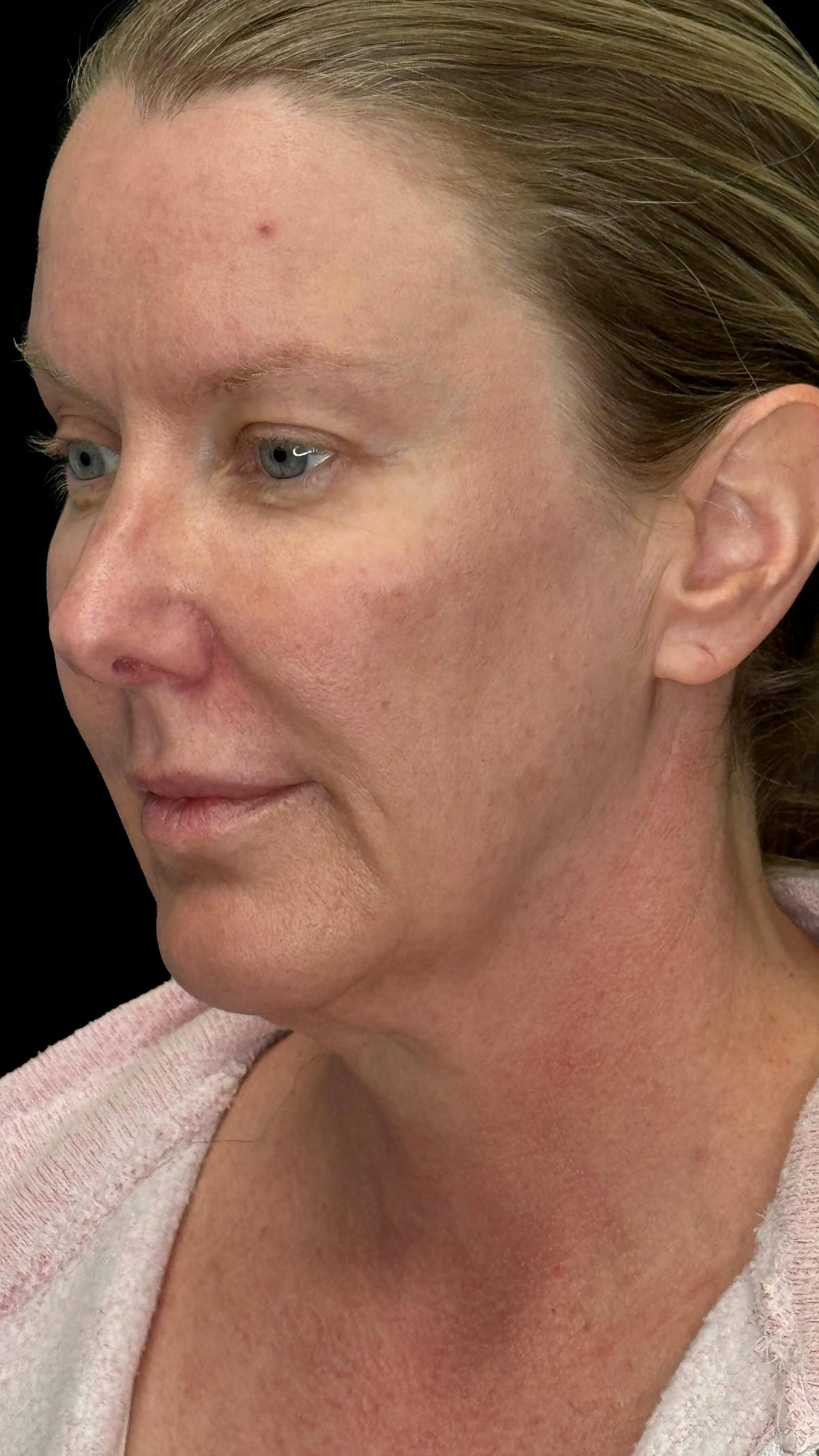 Deep plane facelift patient 1, before