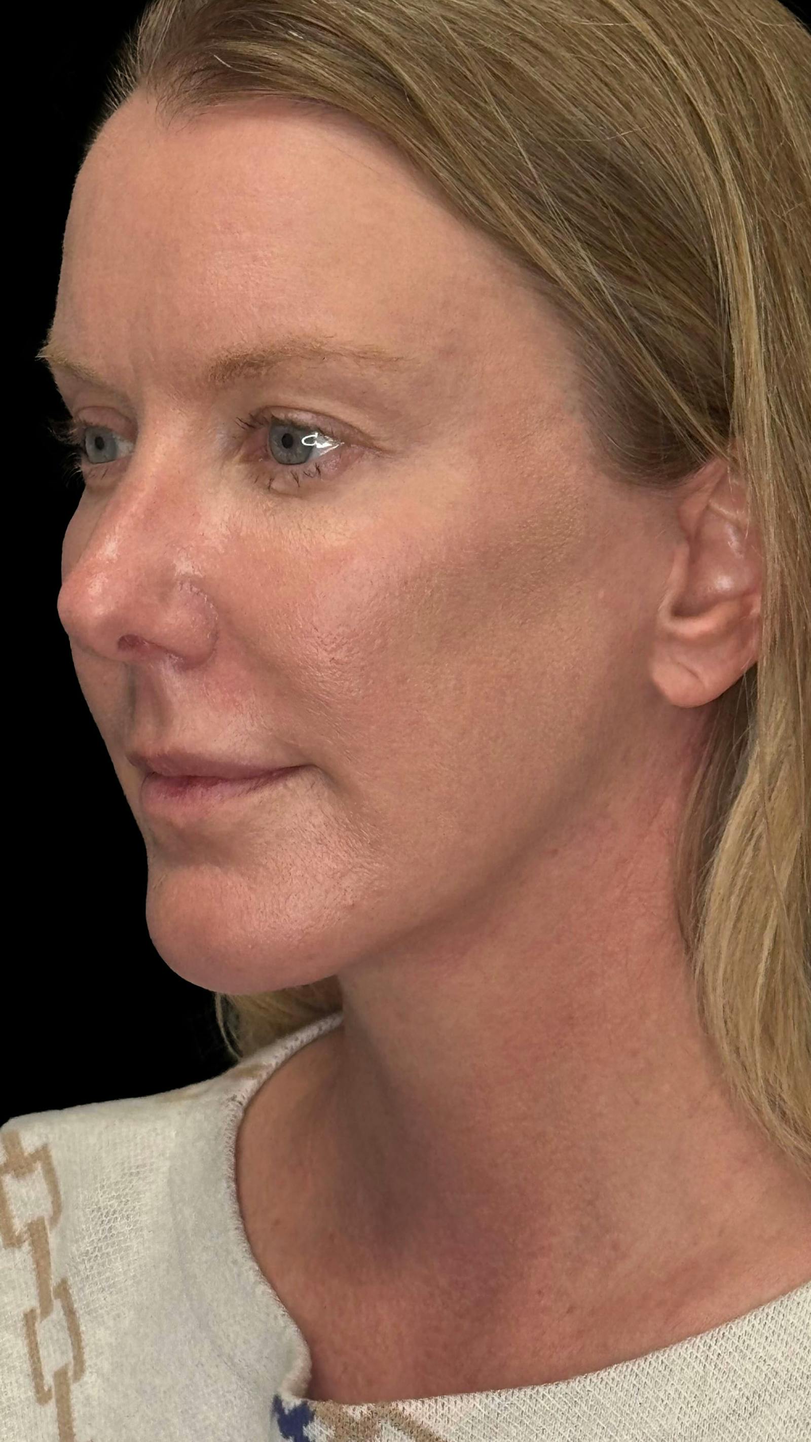 Deep plane facelift patient 1, after