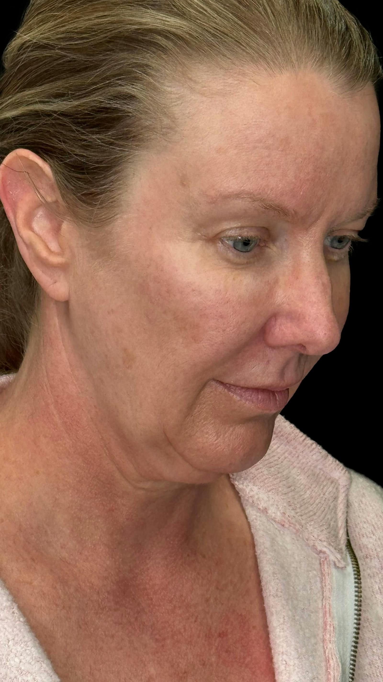 Deep plane facelift patient 2, before