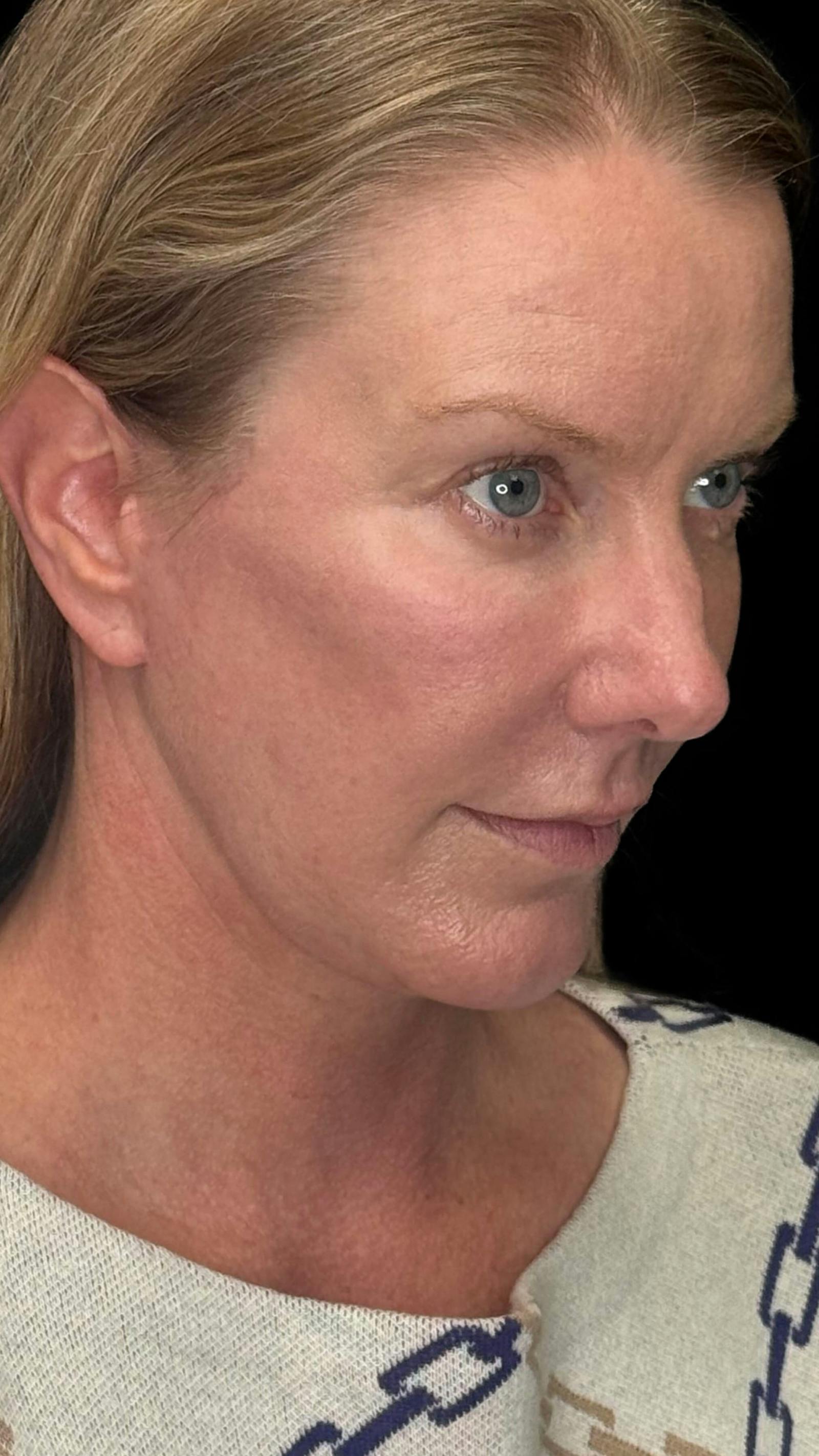 Deep plane facelift patient 2, after