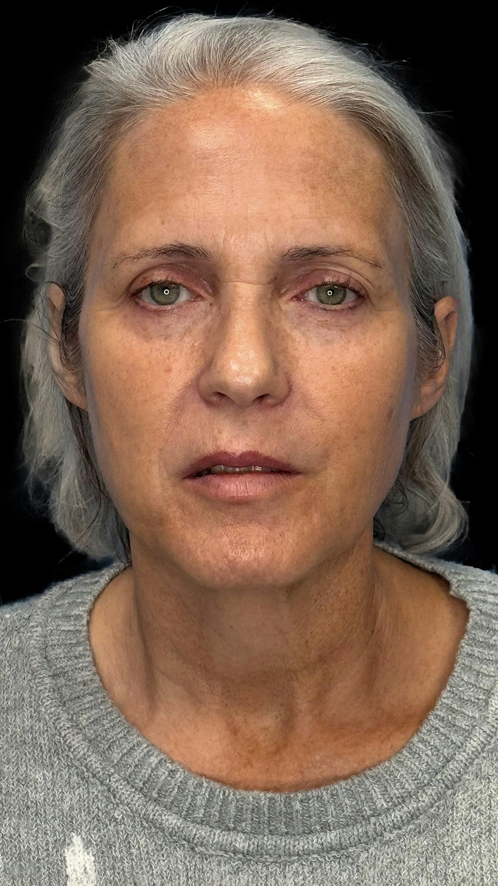 Deep plane facelift patient 3, before