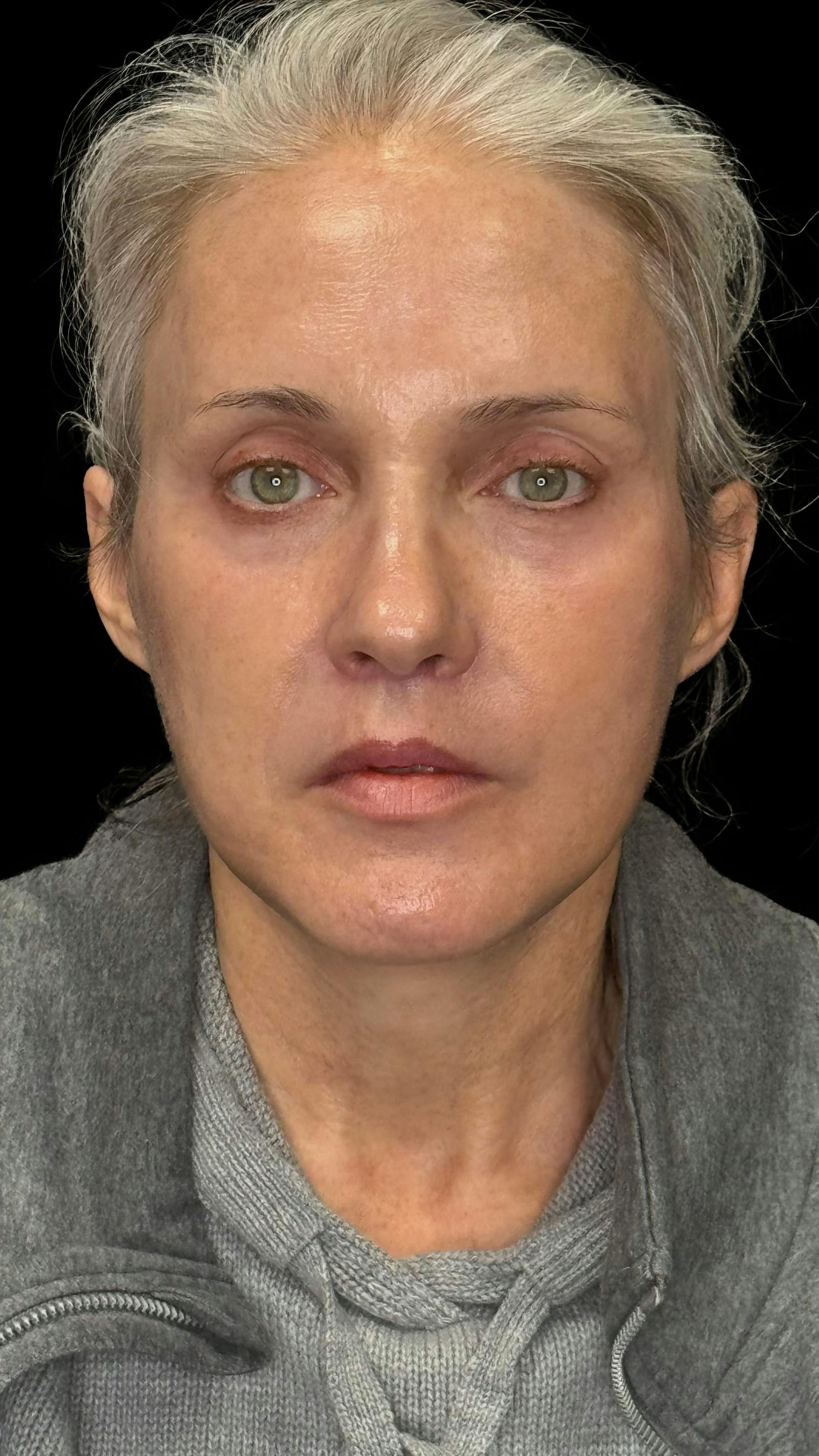 Deep plane facelift patient 3, after