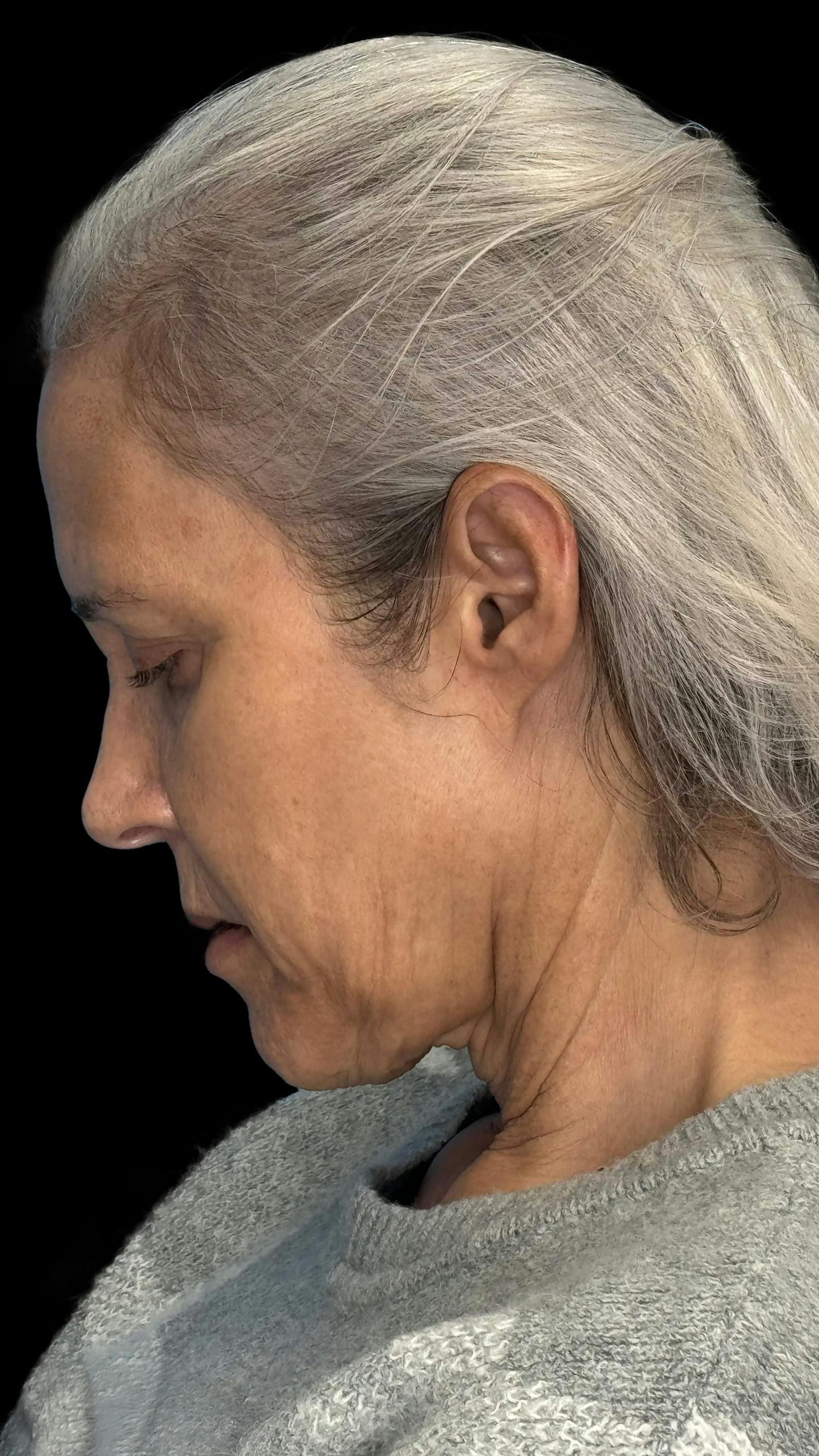 Deep plane facelift patient 4, before
