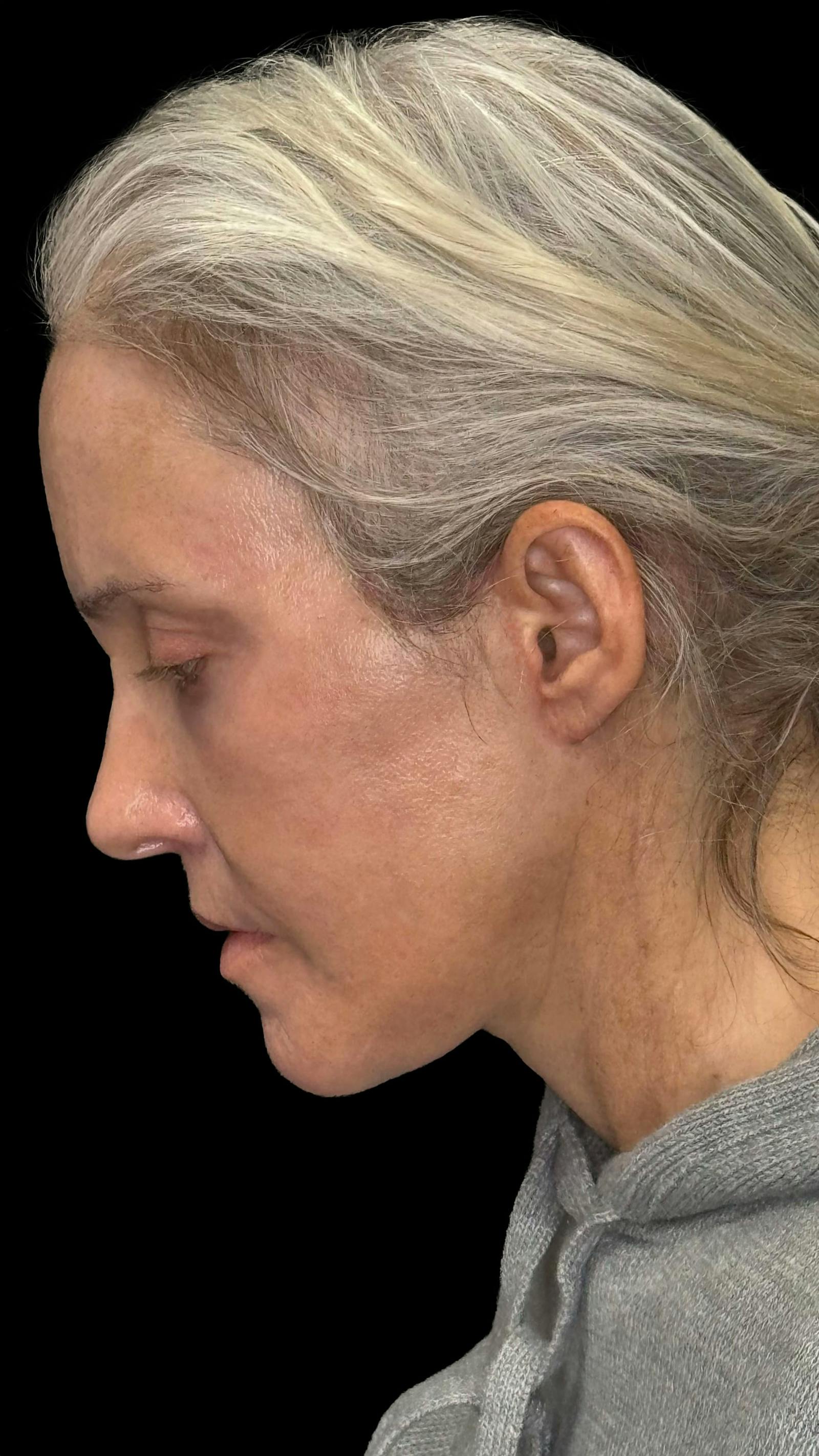 Deep plane facelift patient 4, after