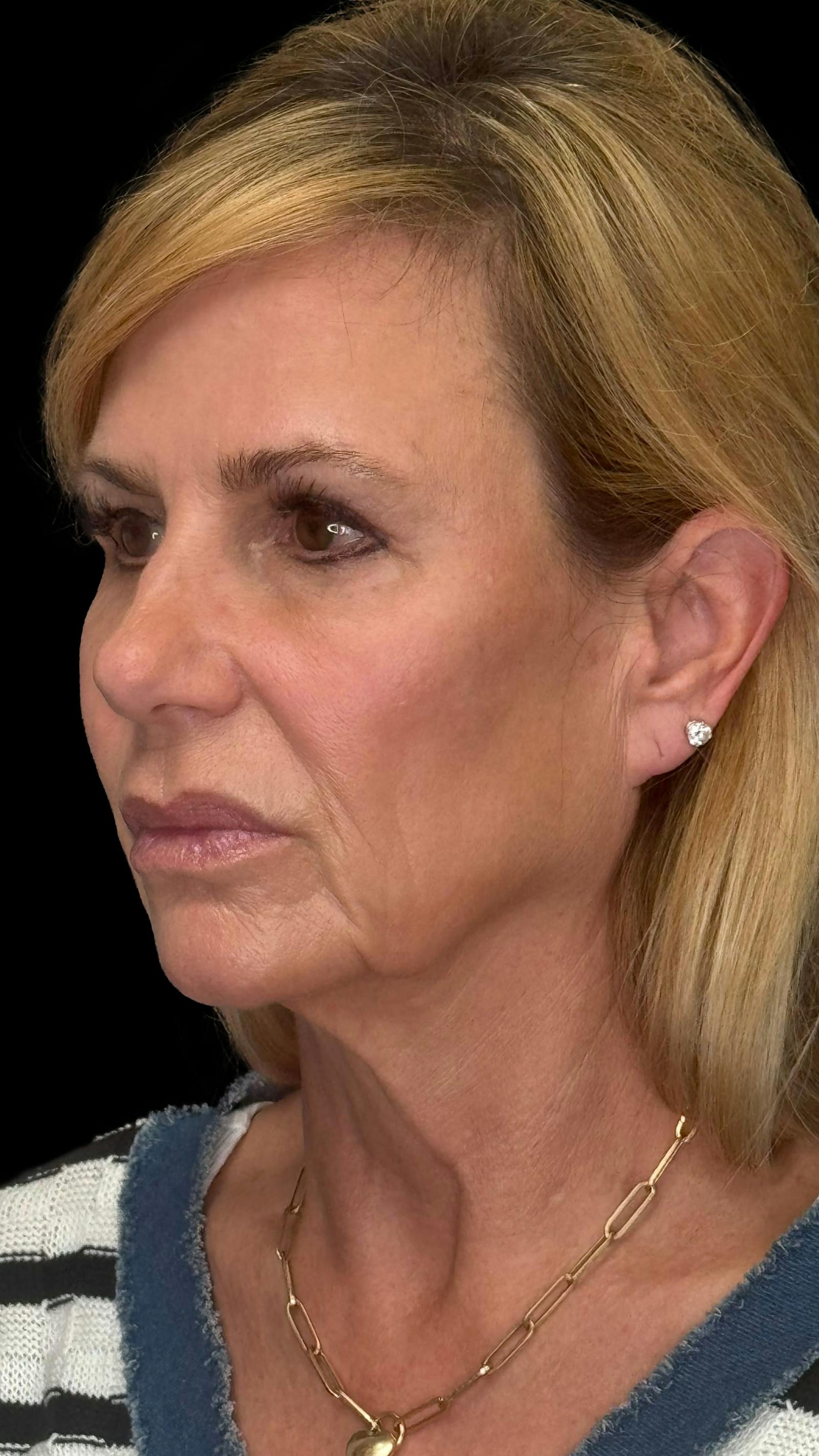 Deep plane facelift patient 5, before