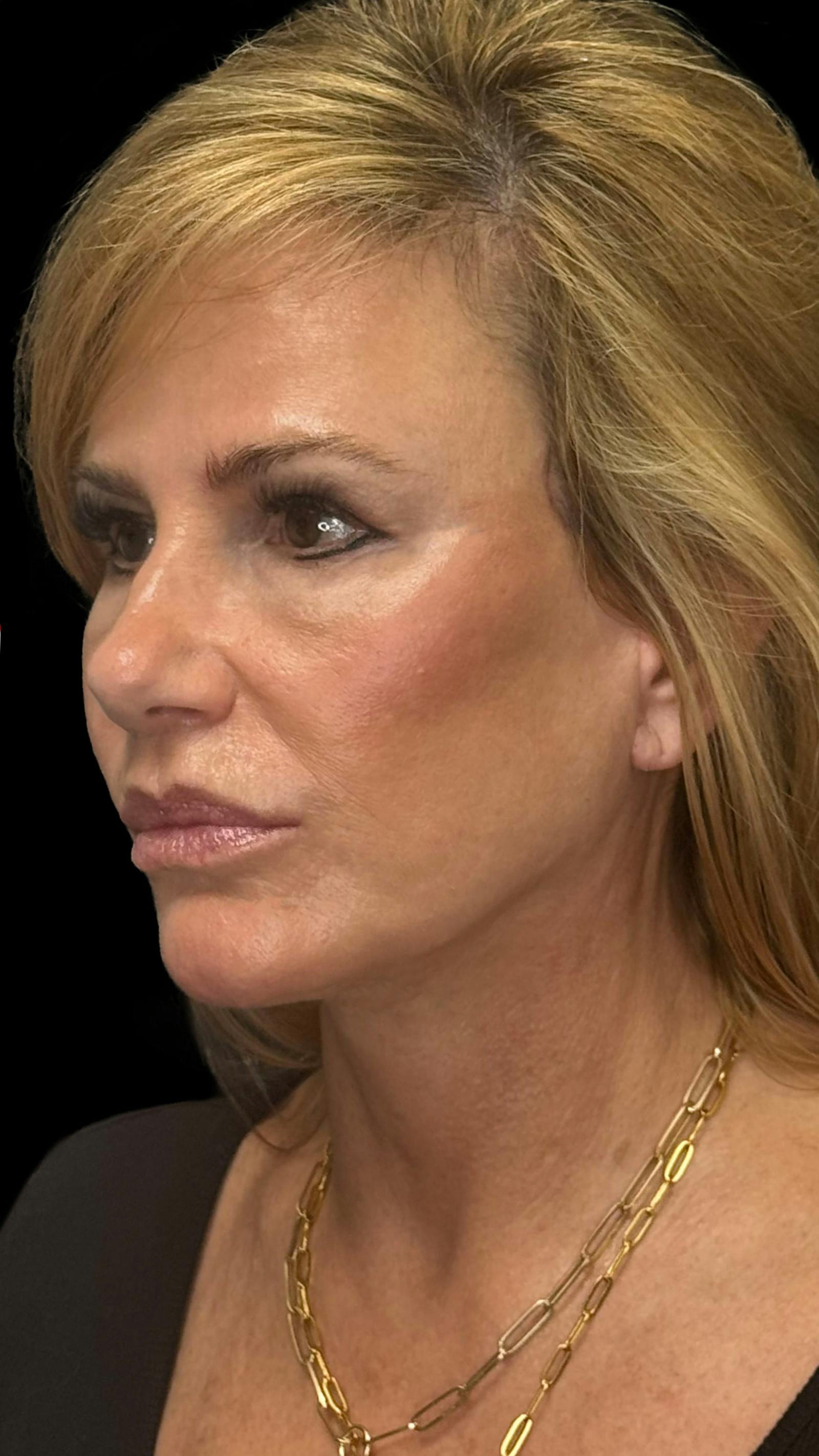 Deep plane facelift patient 5, after
