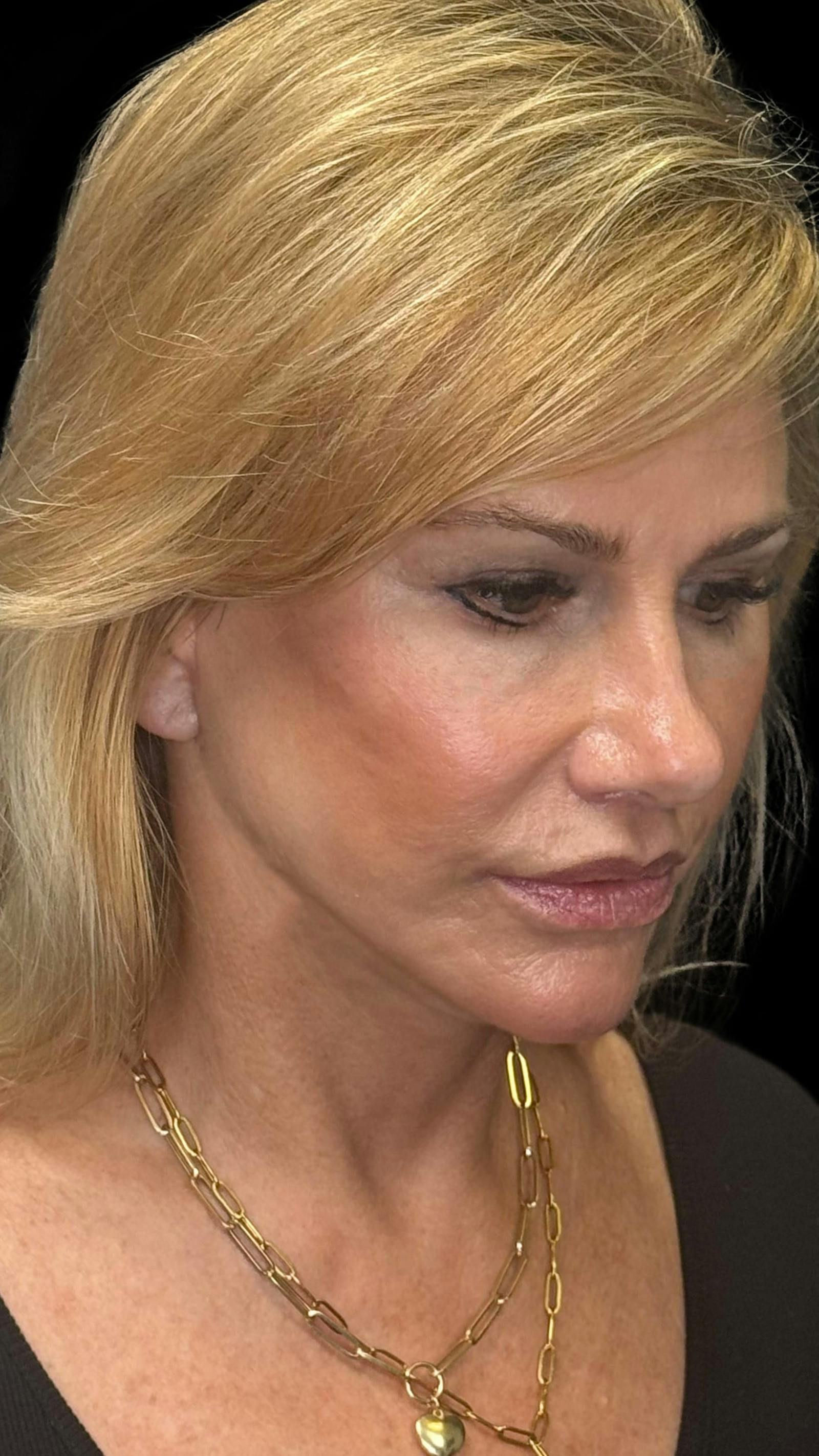 Deep plane facelift patient 6, after