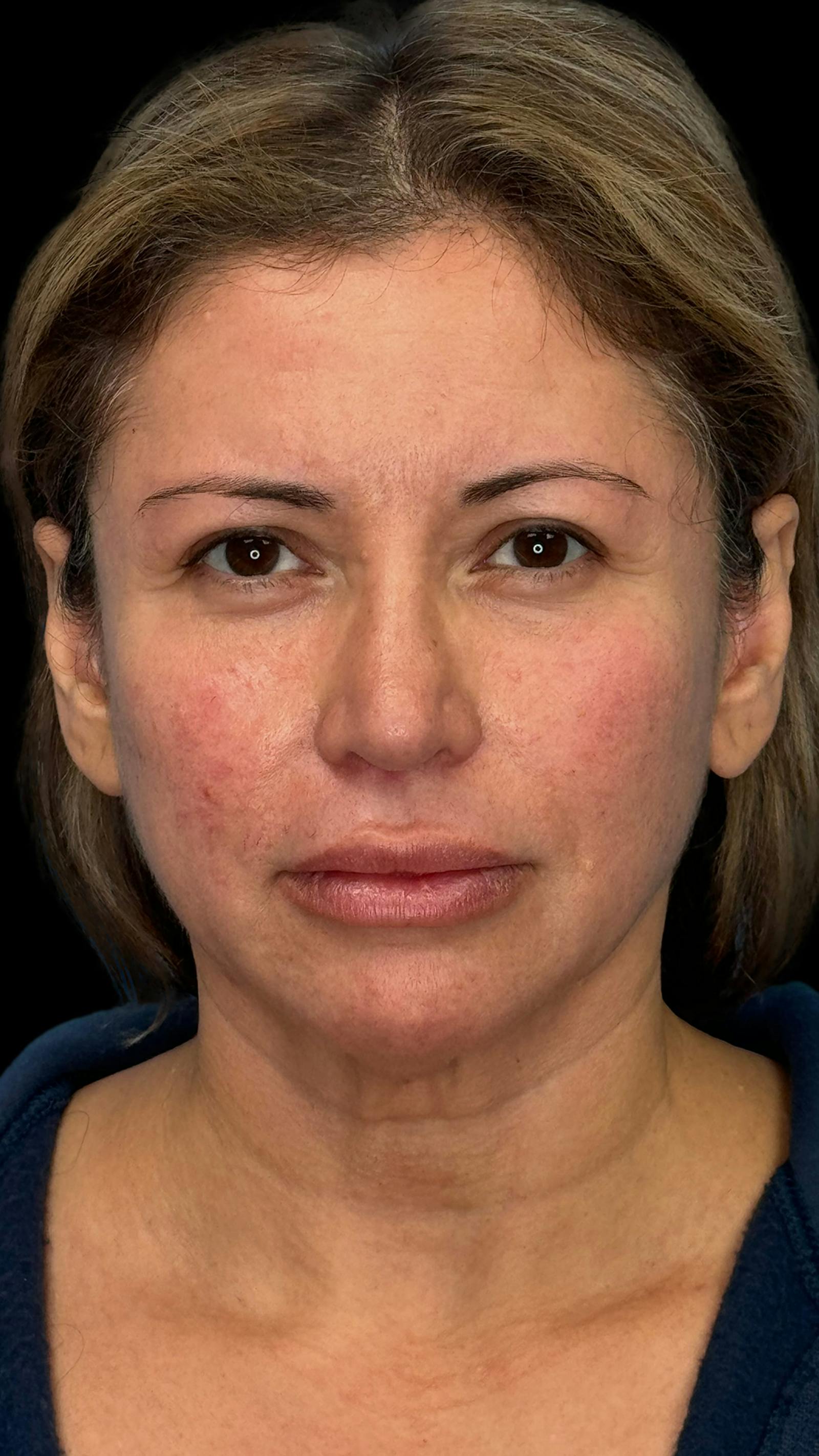 Deep plane facelift patient 7, before