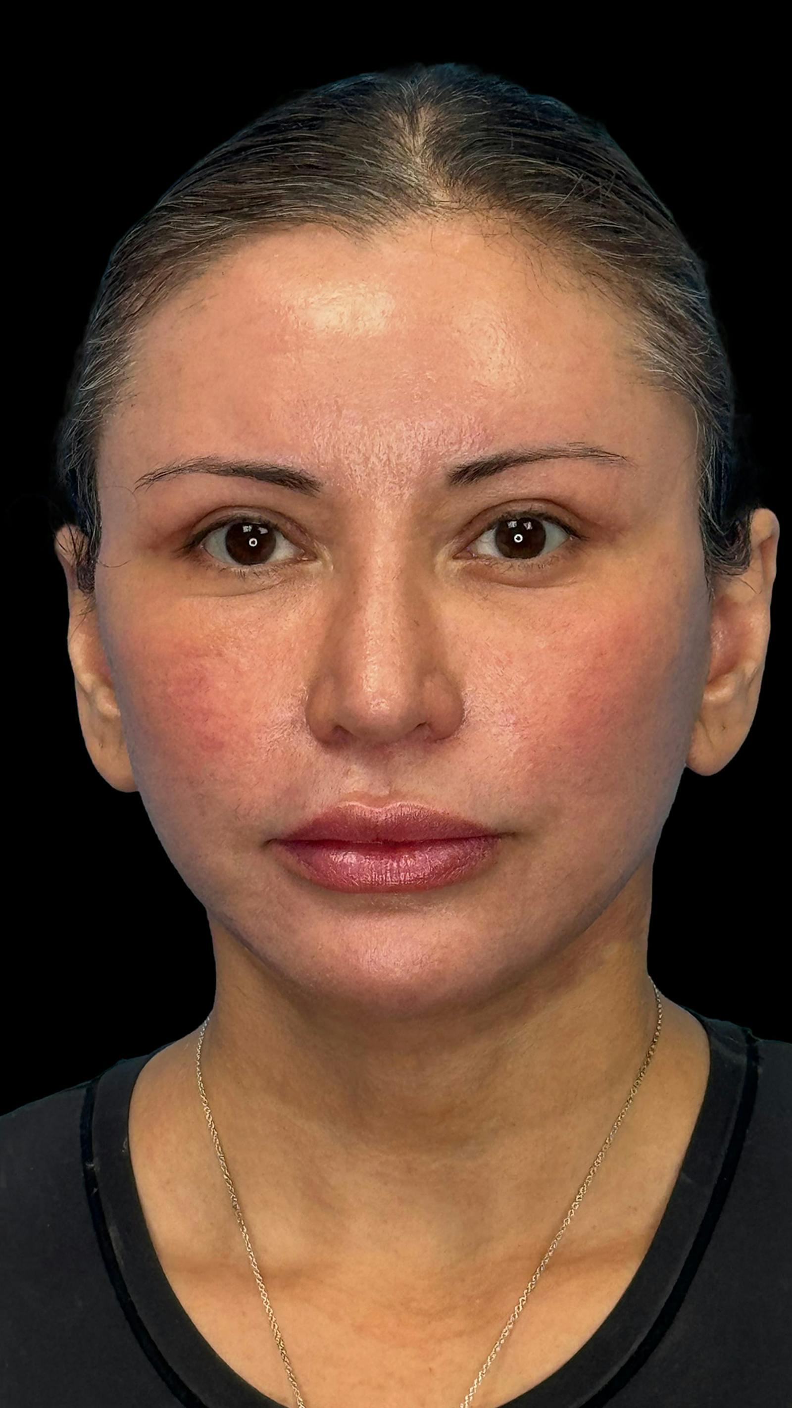 Deep plane facelift patient 7, after