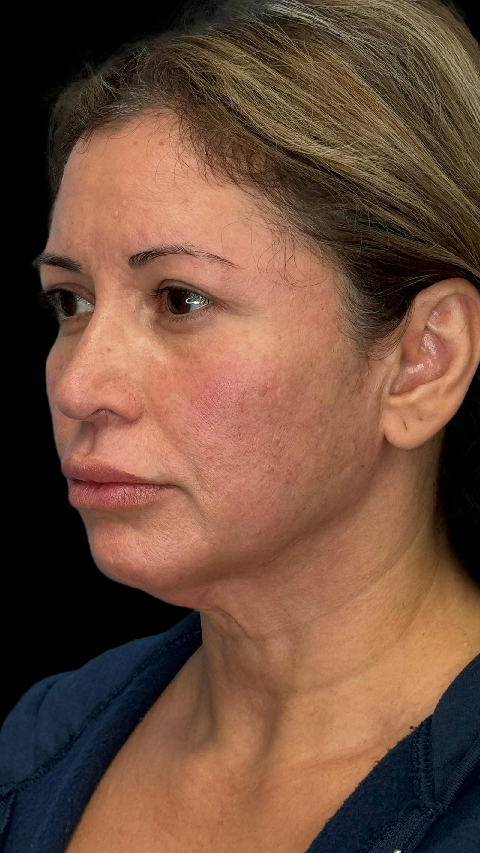 Deep plane facelift patient 8, before