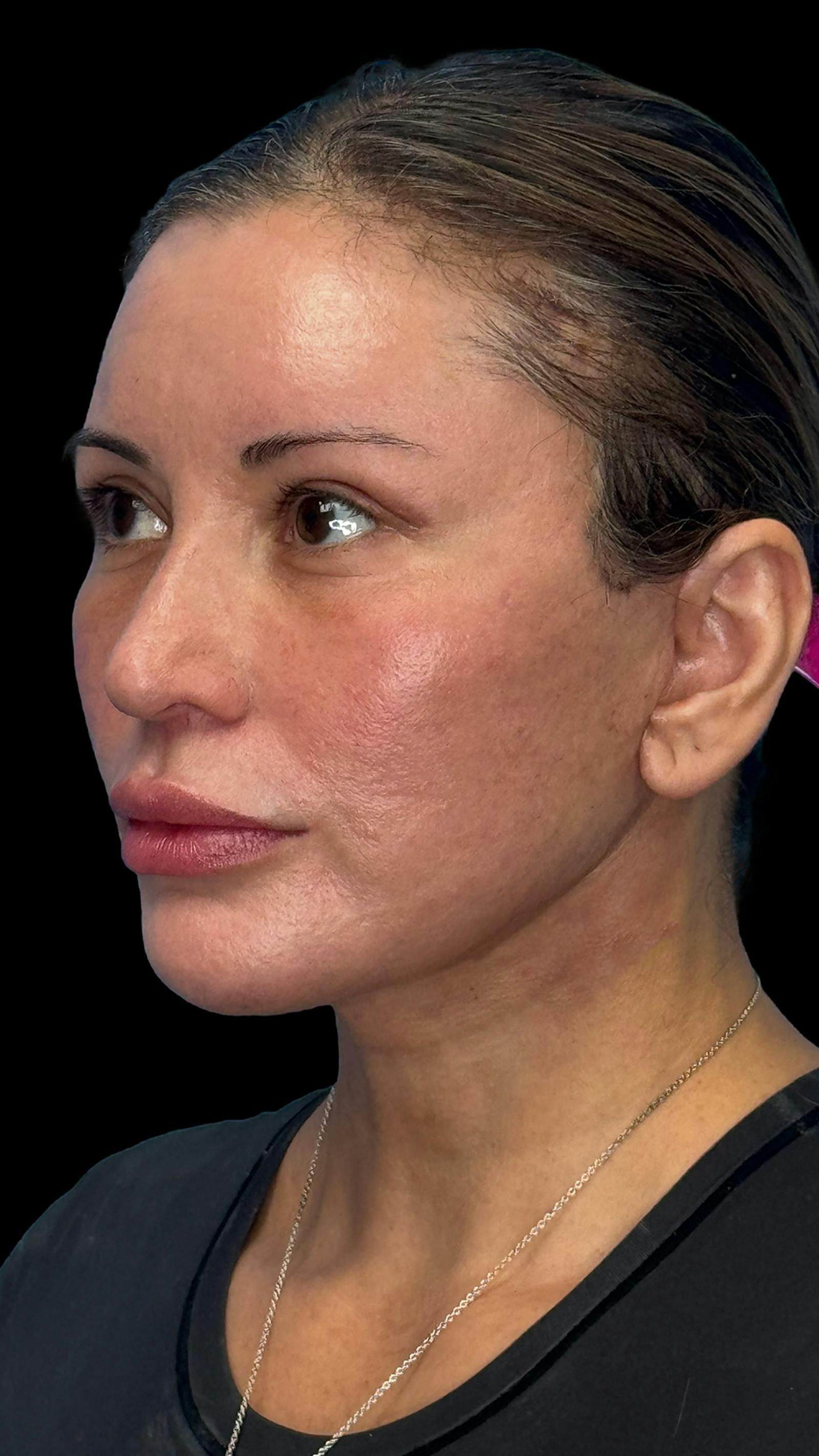 Deep plane facelift patient 8, after