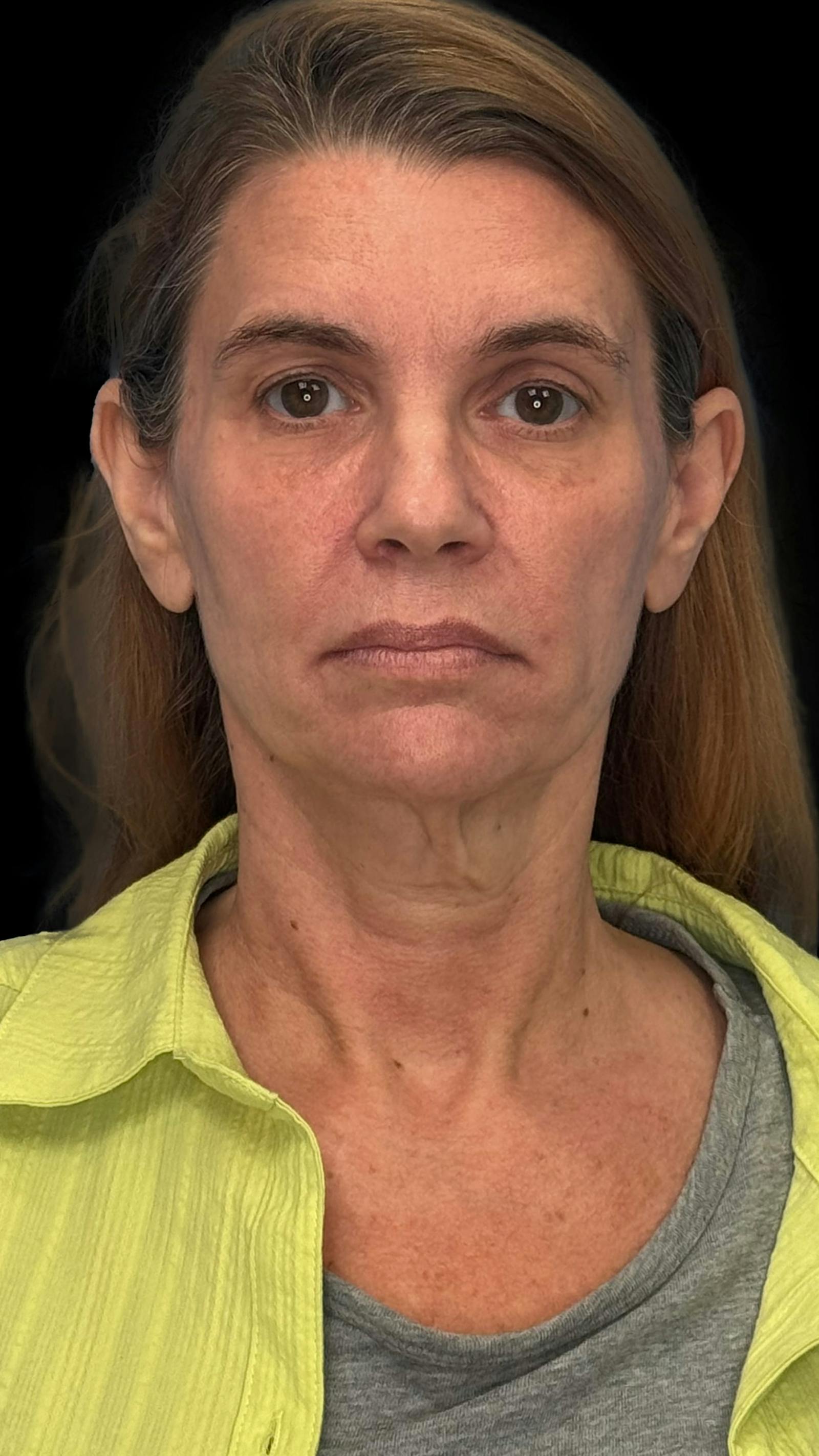 Deep plane facelift patient 9, before