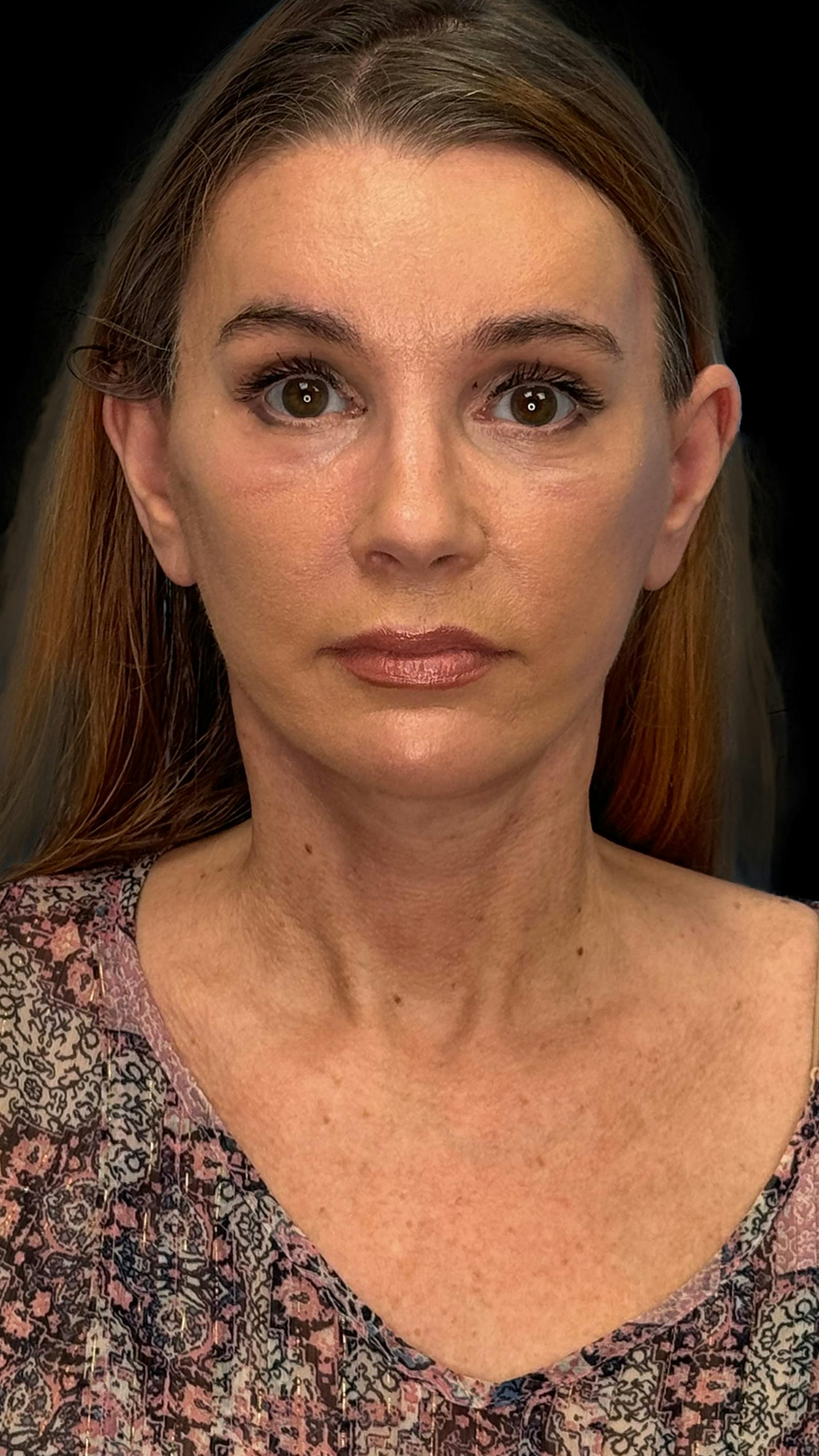 Deep plane facelift patient 9, after
