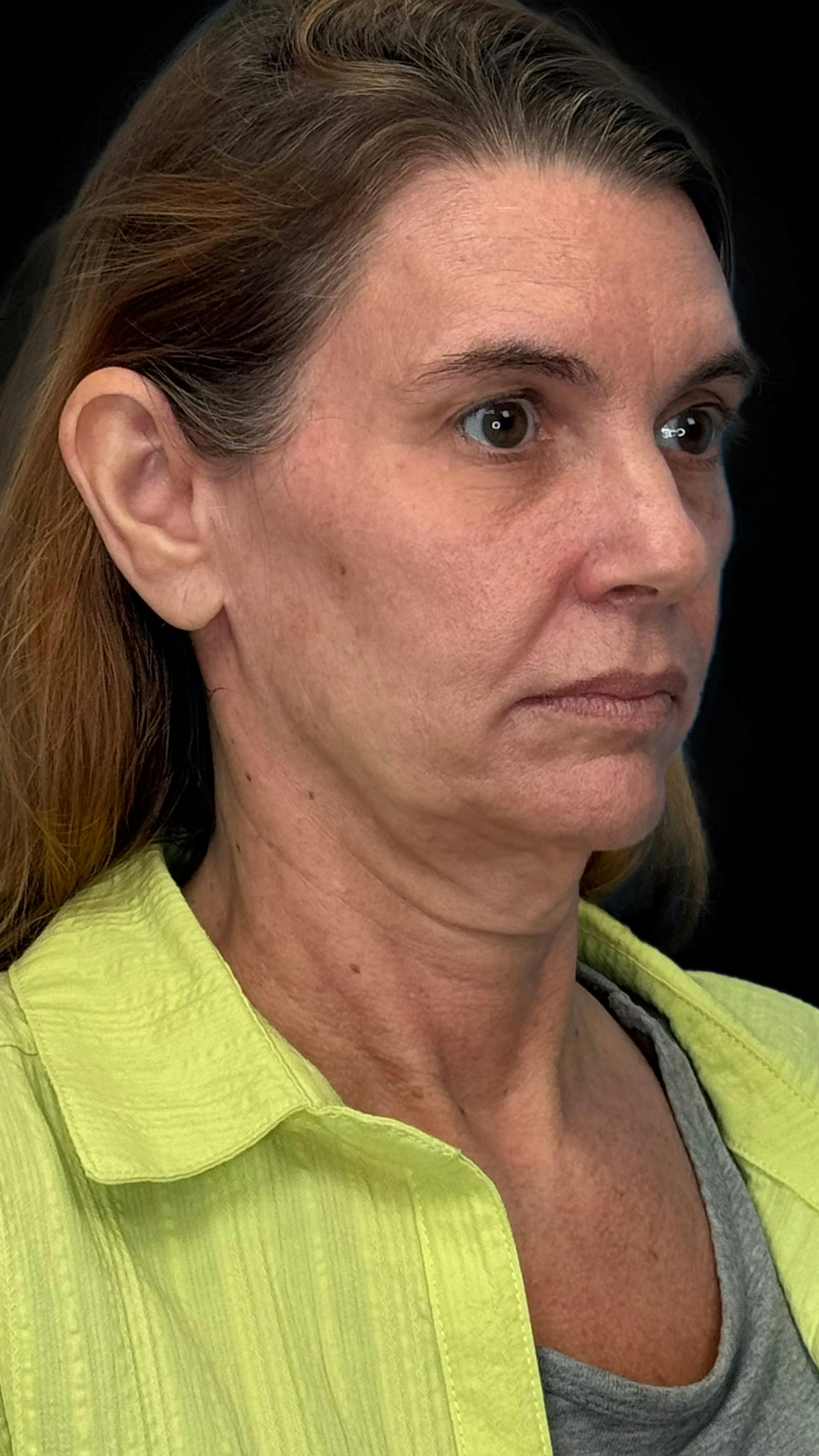 Deep plane facelift patient 10, before