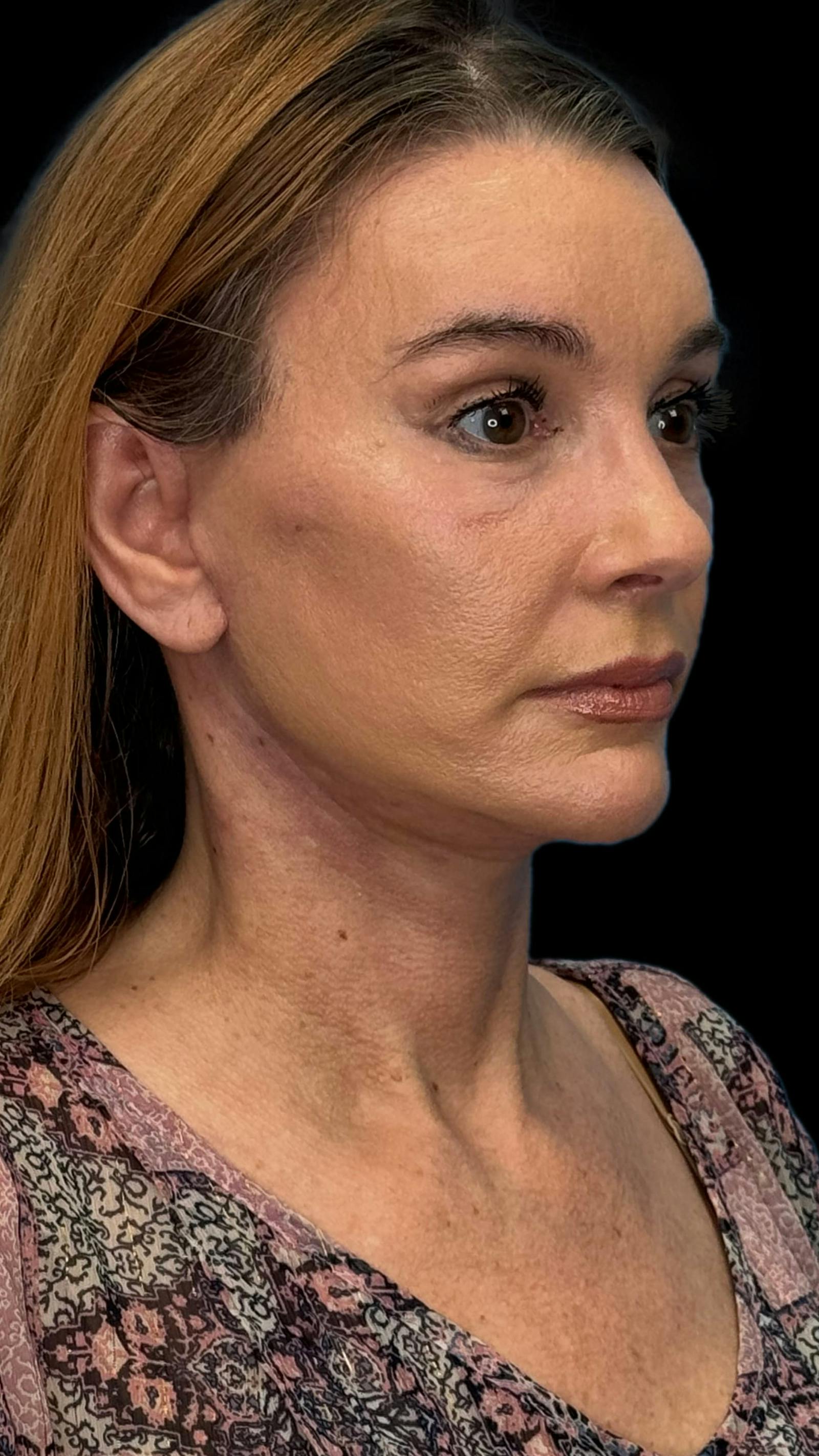 Deep plane facelift patient 10, after