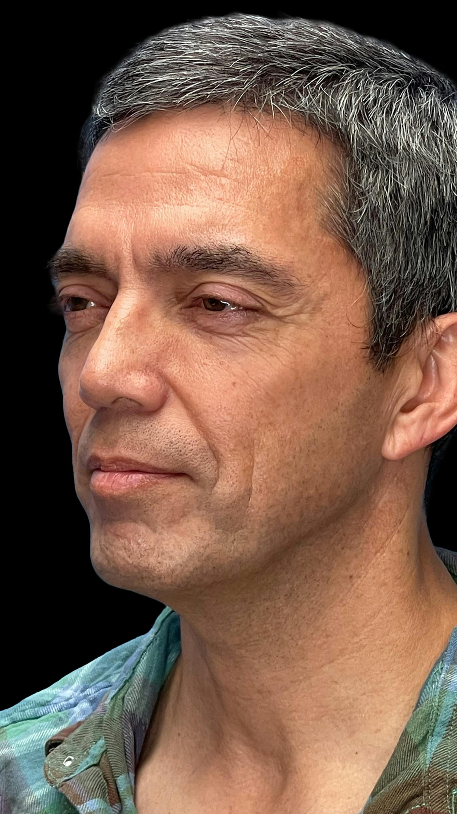 Deep plane facelift patient 11, before