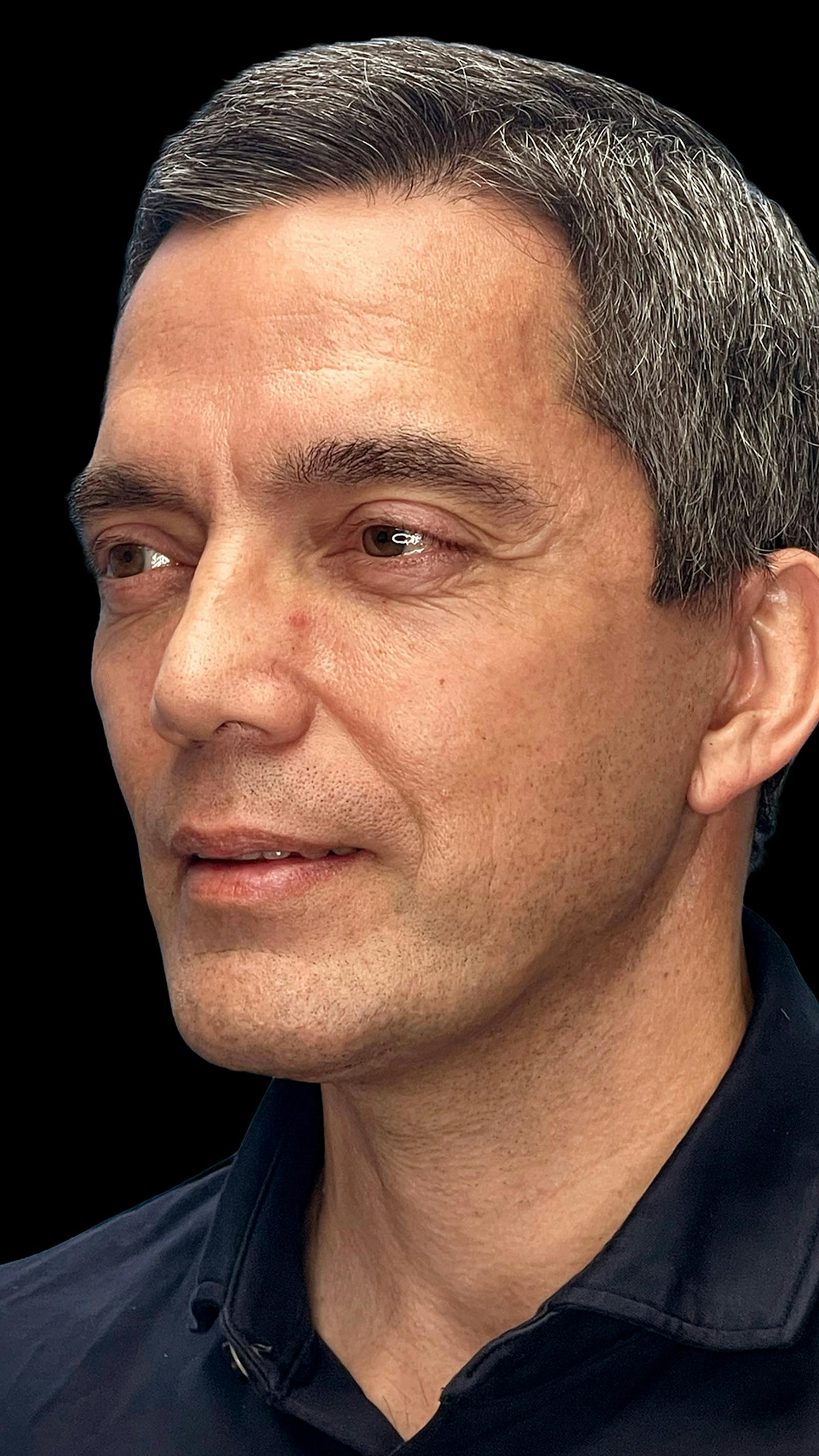 Deep plane facelift patient 11, after