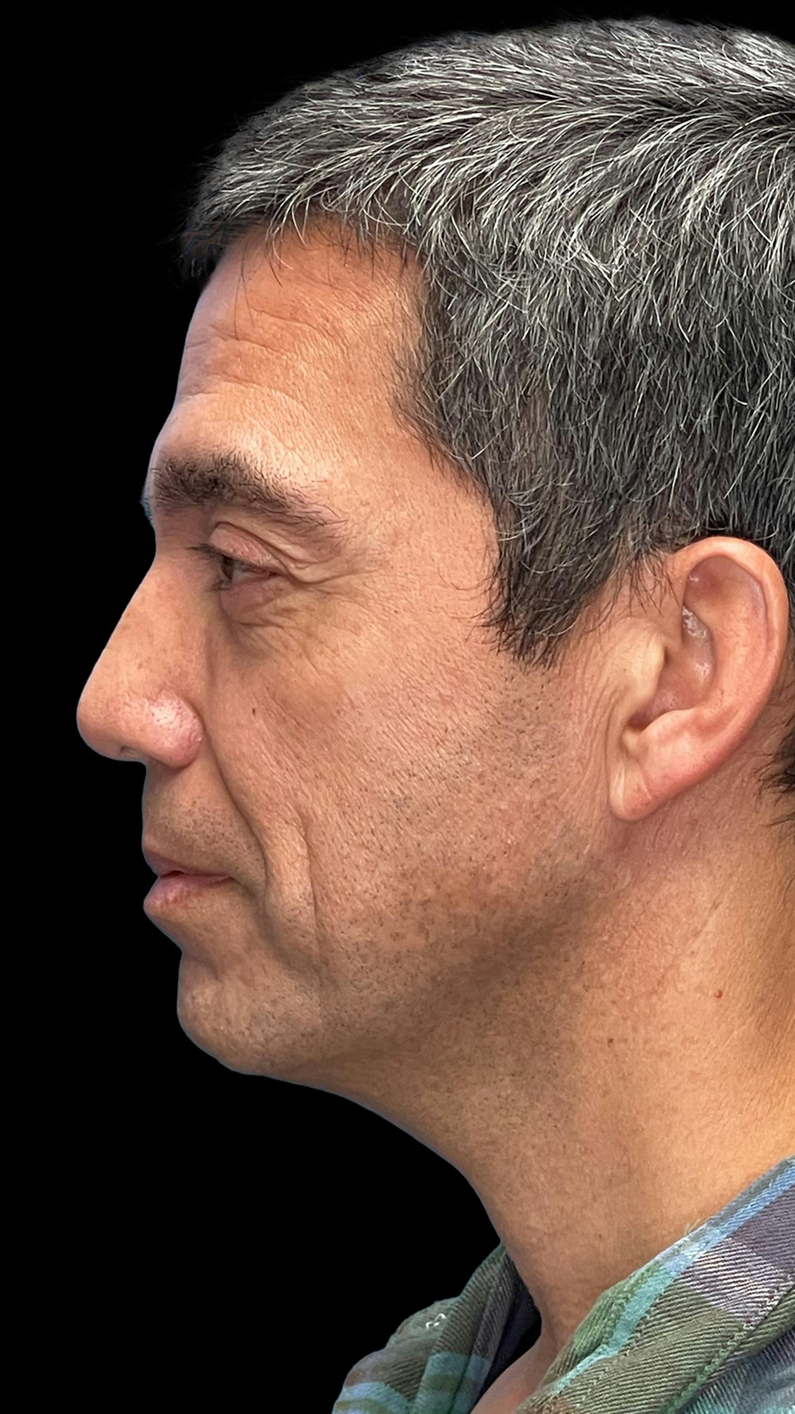Deep plane facelift patient 12, before