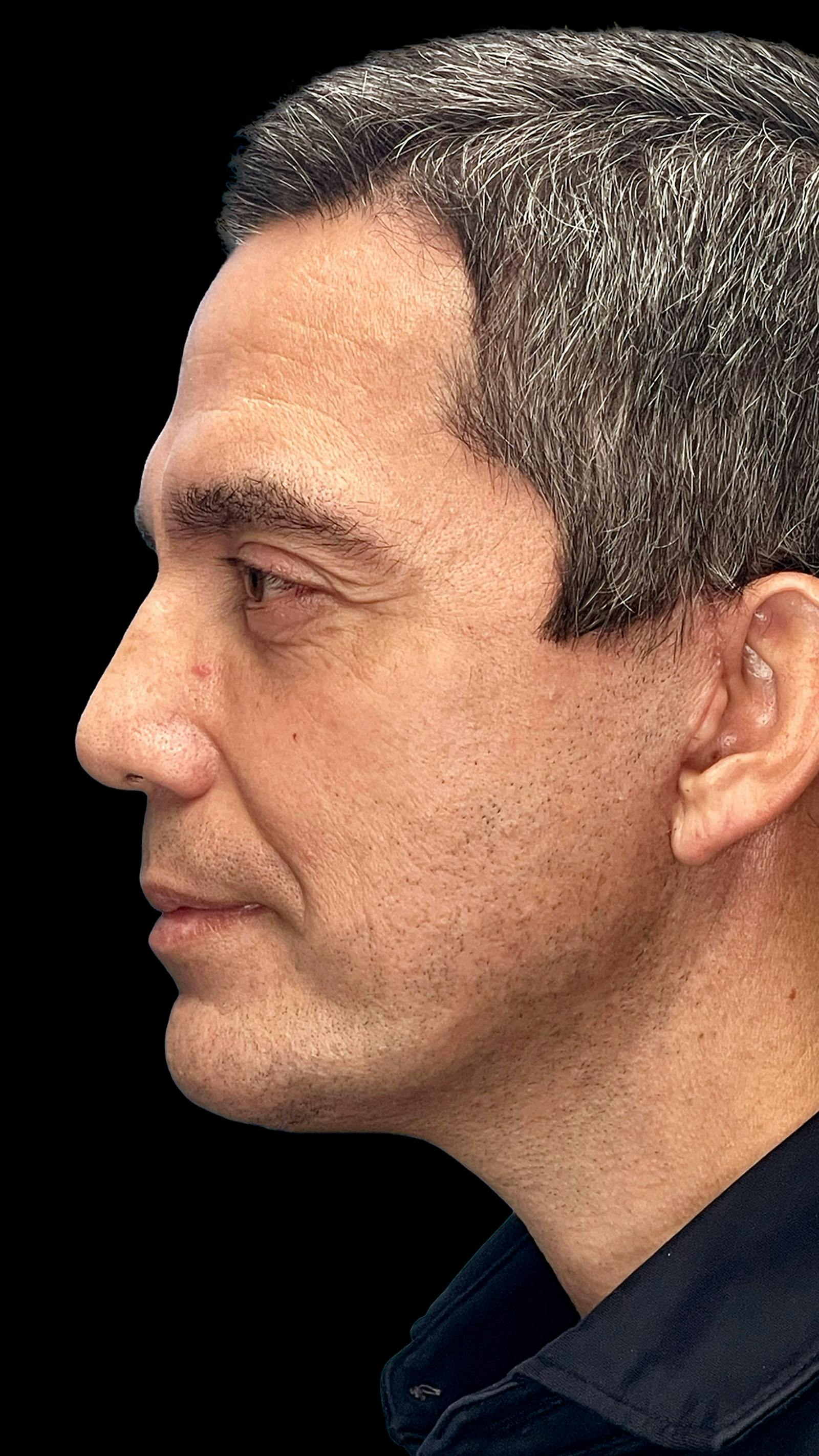 Deep plane facelift patient 12, after