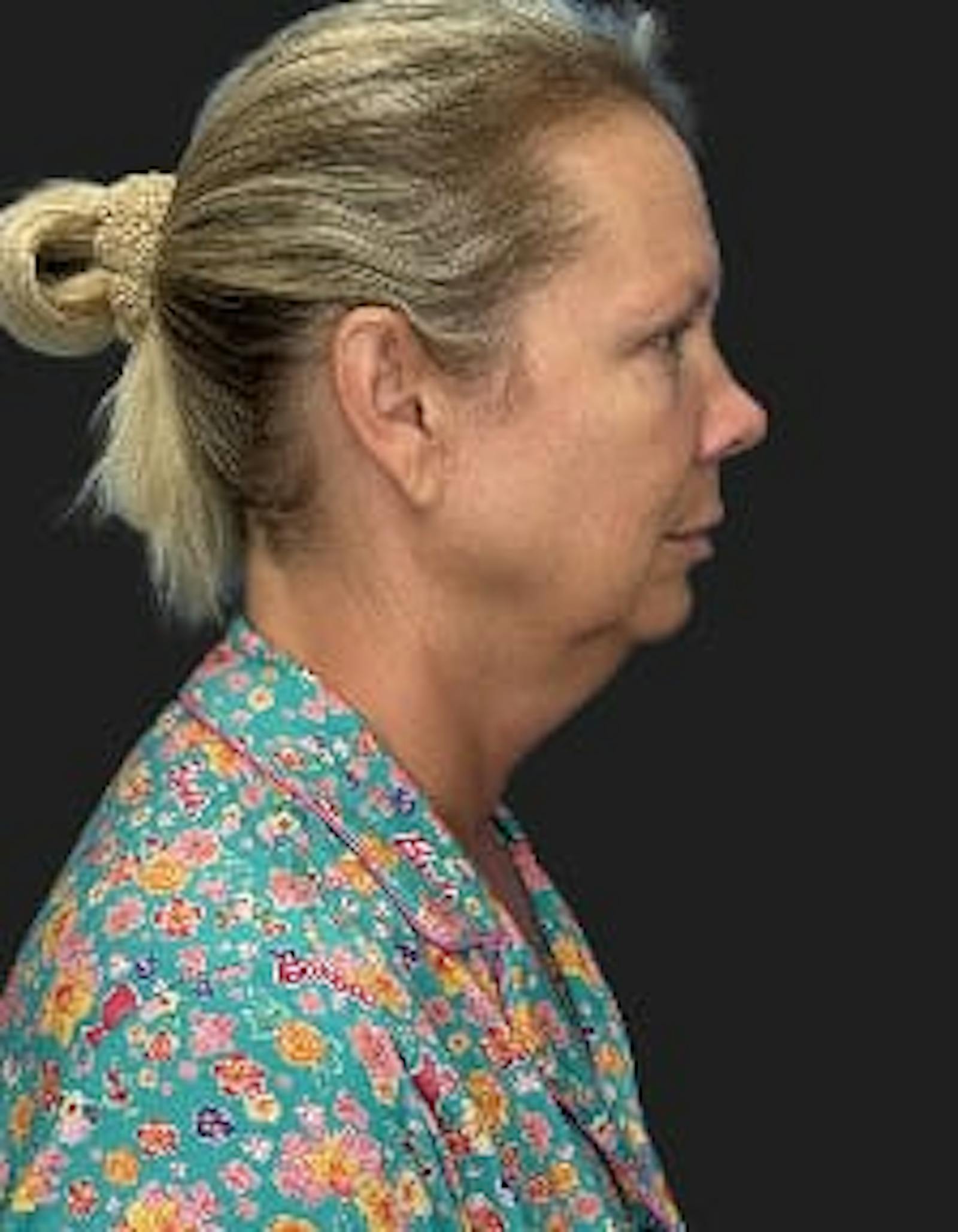 Patient 1, before number 3