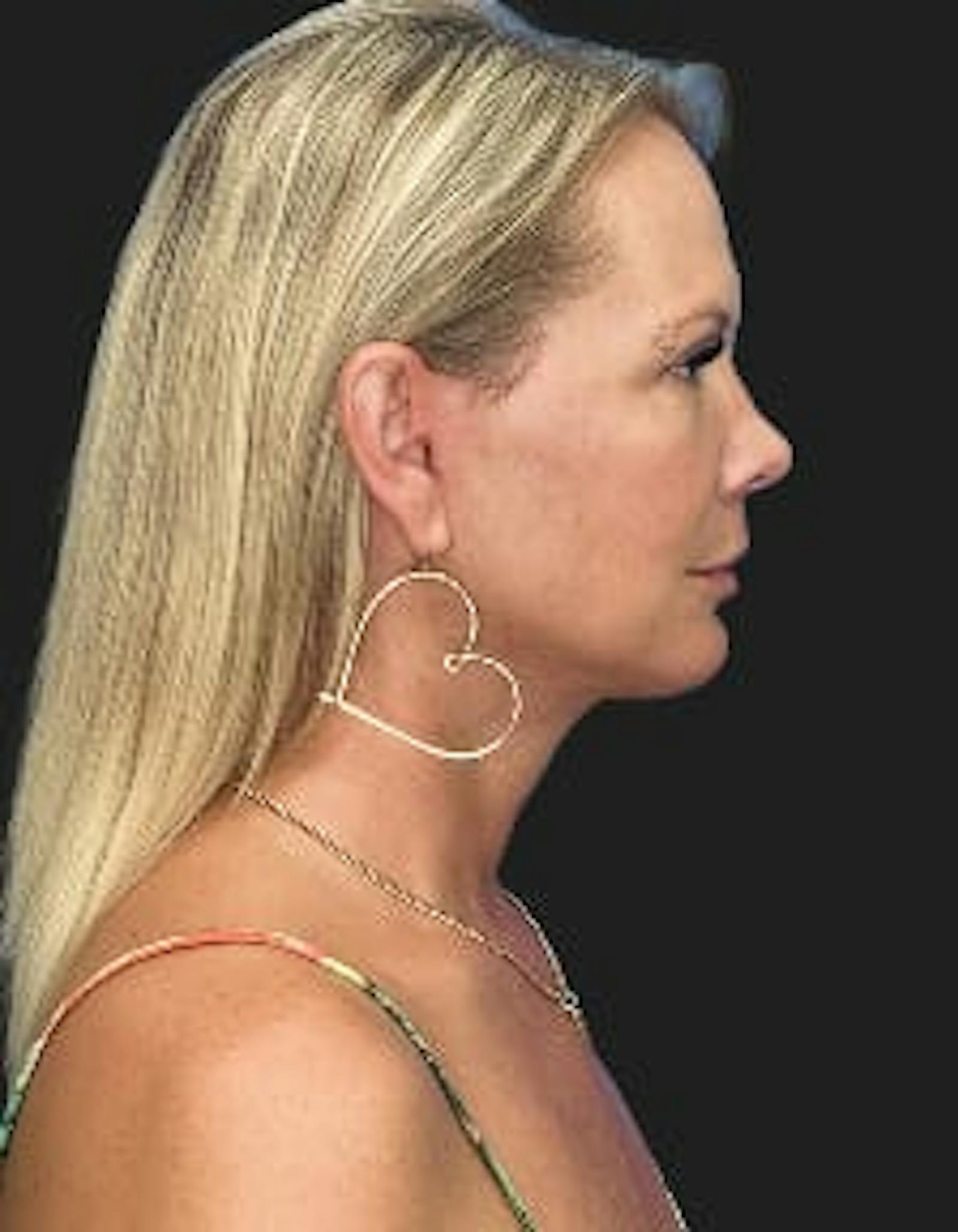 Patient 1, after number 3