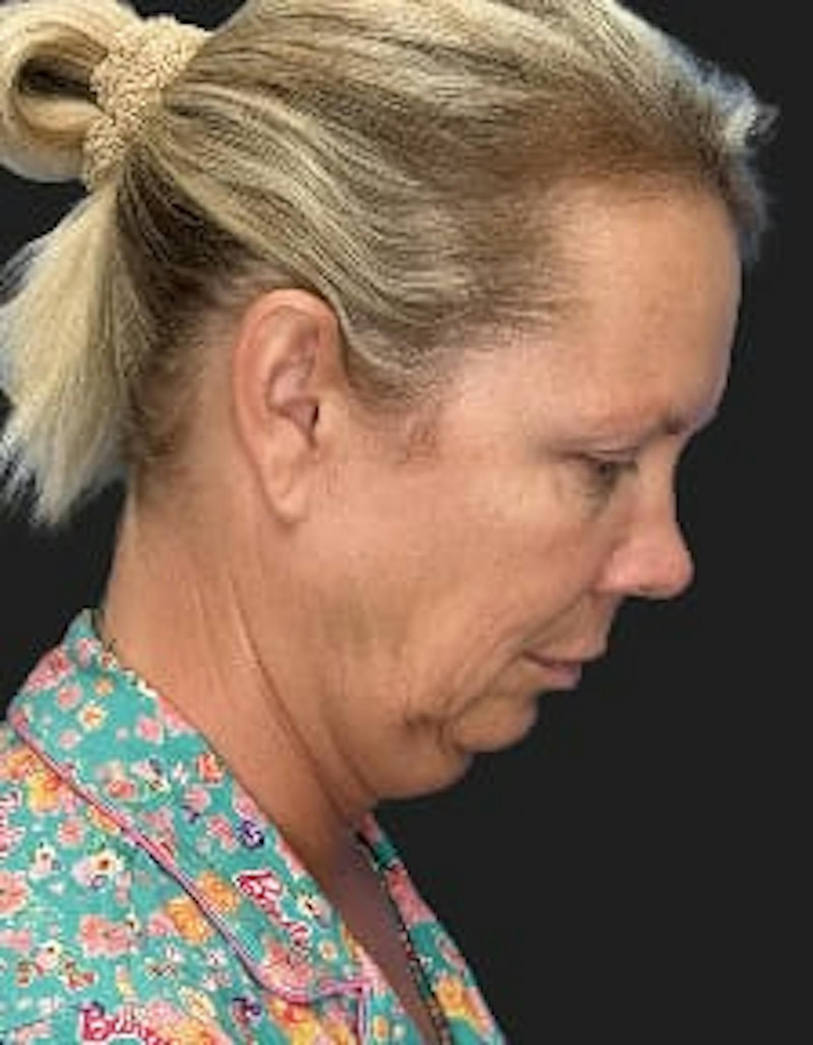 Patient 1, before number 4