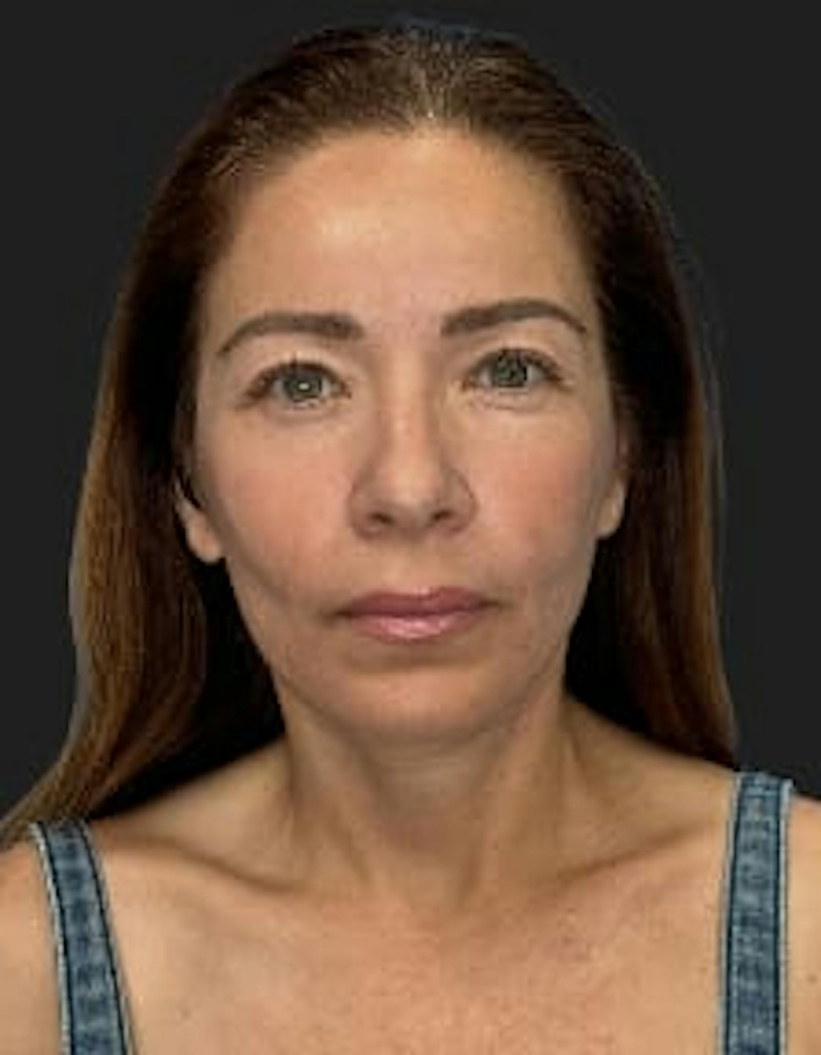 Patient 2, after number 1