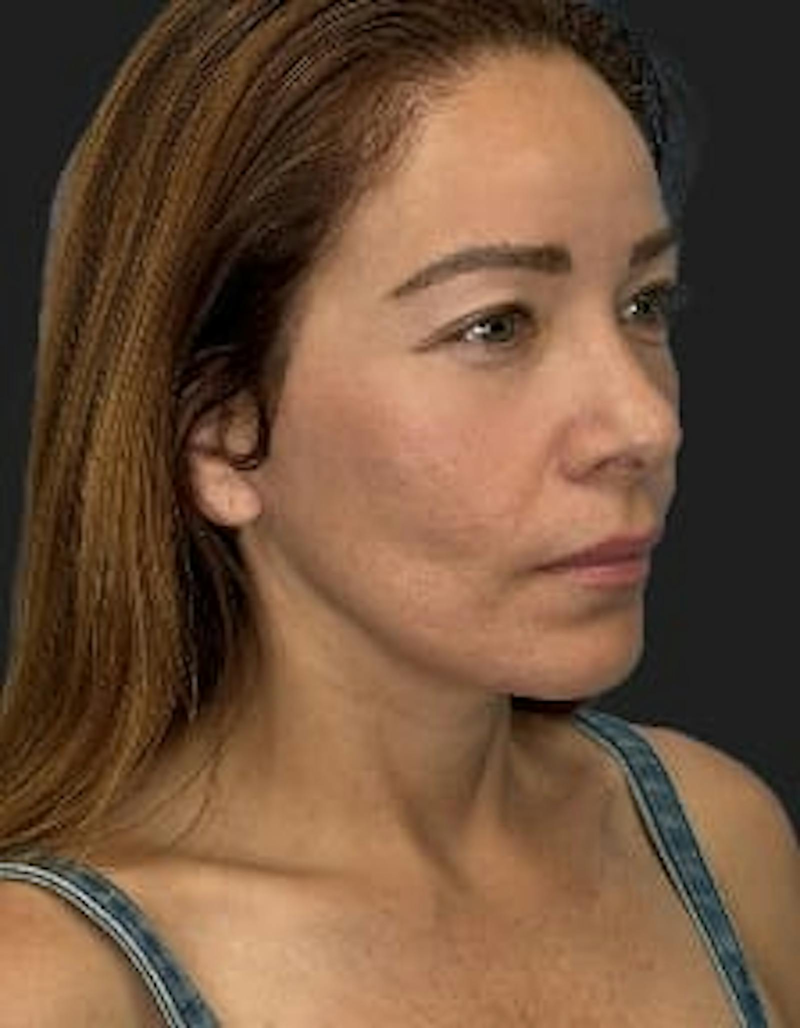 Patient 2, after number 2