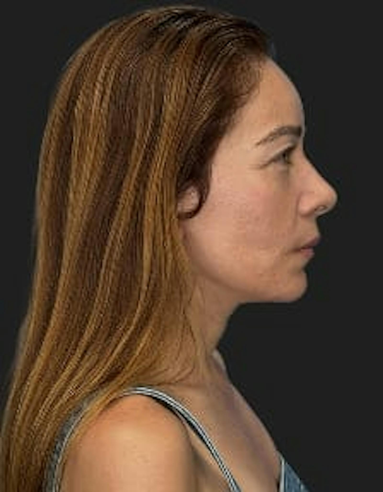 Patient 2, after number 3