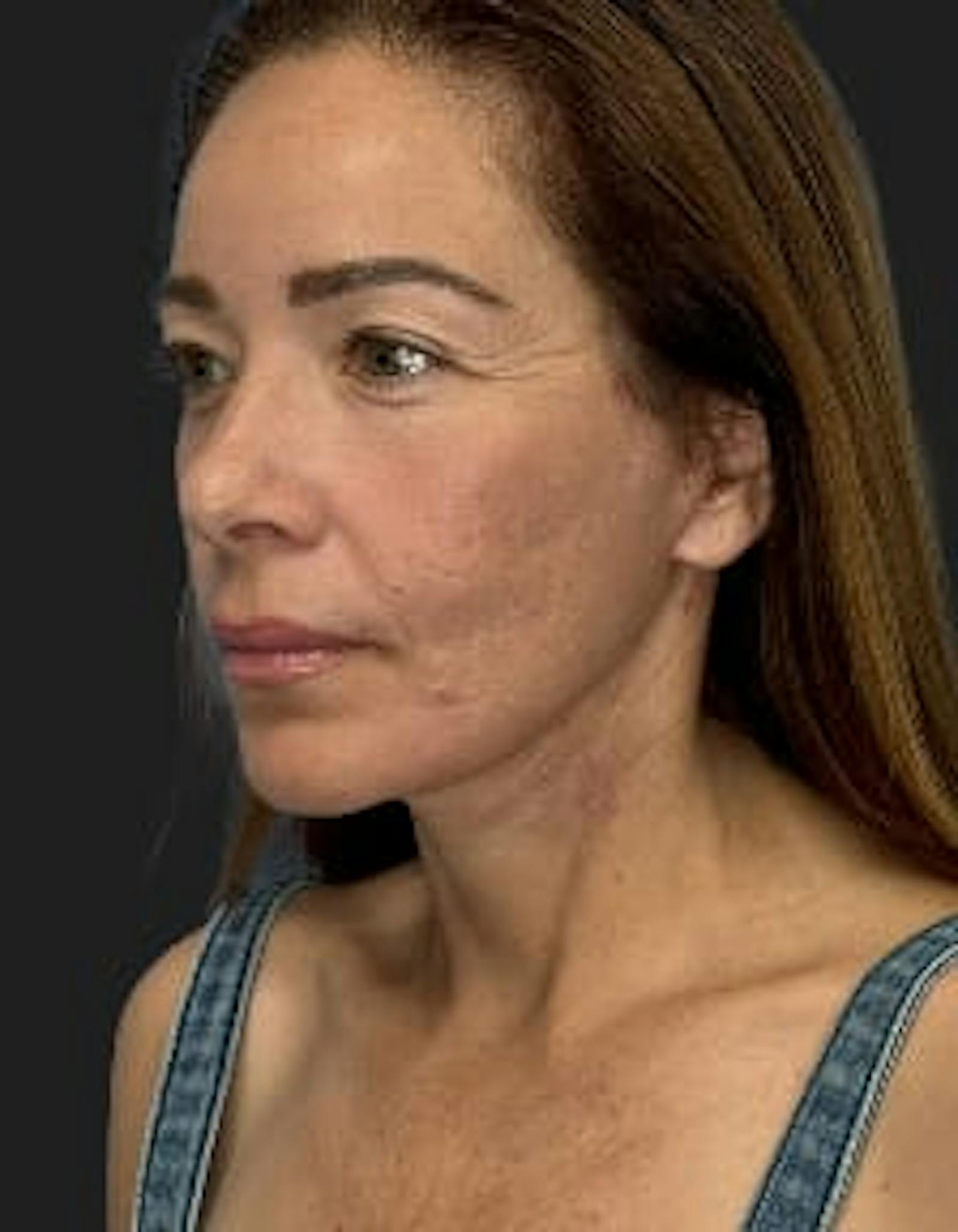 Patient 2, after number 4