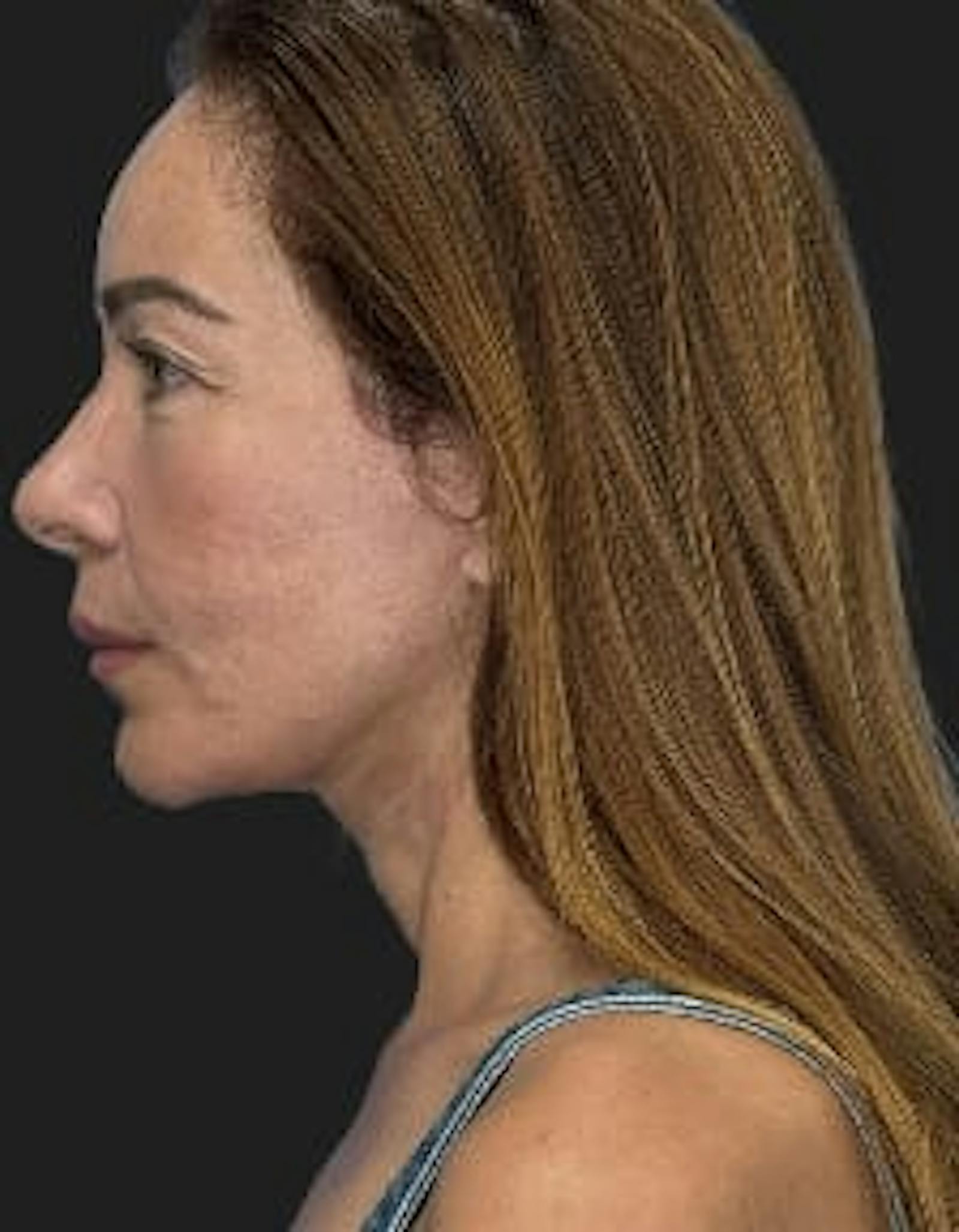 Patient 2, after number 5
