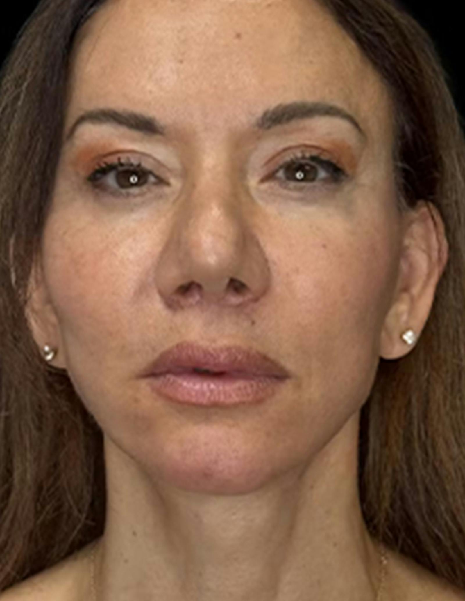 Patient 3, after number 1
