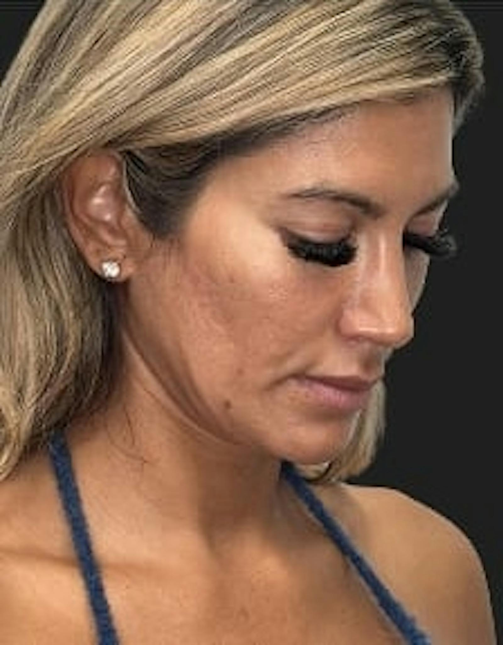 Patient 4, before number 4