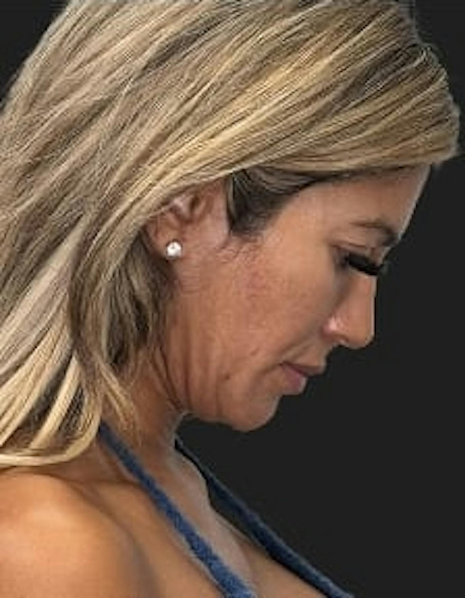 Patient 4, before number 5